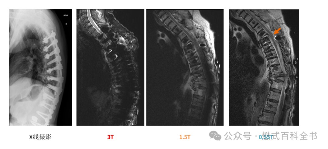 图 6:不同场强的 MRI 对于植入物成像效果比较